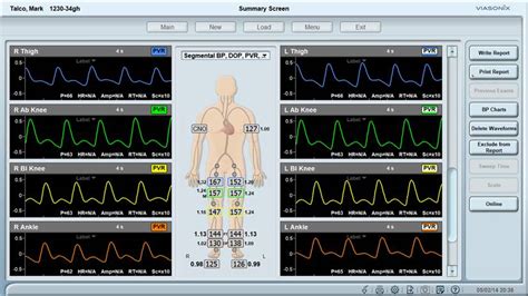 FAQ about Pulse Volume Recording (PVR) .